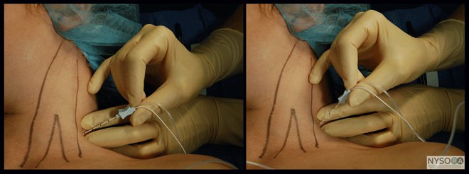 1.1.5. Межлестничный доступ (interscalene)