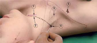 1.1.2. Надключичный доступ (supraclavicular)