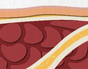1.1.4. Межлестничная блокада плечевого сплетения