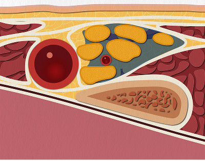 1.1.3. Надключичный доступ