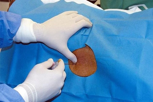  Нейроаксиальные блокады